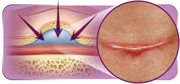 Seroma Na Cicatriz Conhe A Tratamentos E Preven Es Servimedic Technology